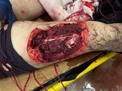 Attacked by a shark