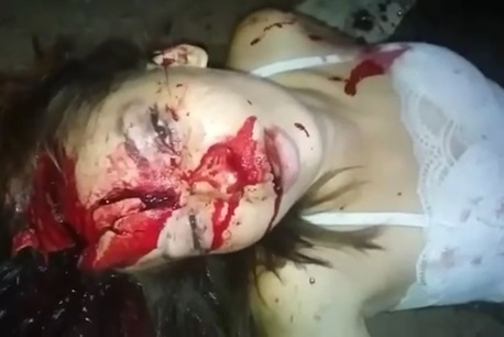 Shocking Video Shows Woman with Destroyed Skull Still Reflex Breathing