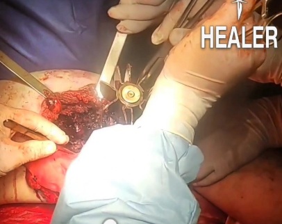 Doctor Removing mortar huge piece stuck in fighter leg