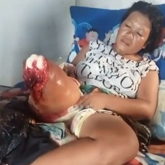 A Crocodile Bit Off The Leg Of A 32-Year-old Woman
