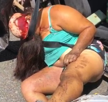 DAMN: Woman Was Horribly Scalped after Crazy Accident