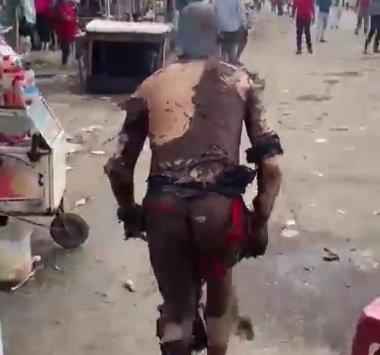 Kenyan man horrifically burned after explosion 
