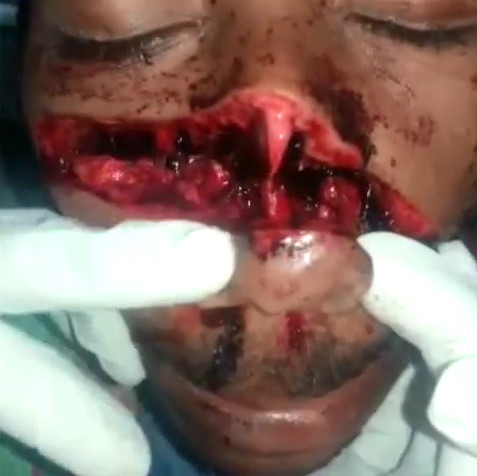 Man Face Hacked with Machete Blows Agonizing 