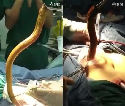 Shocking moment a Woman has an EEL removed from her stomach