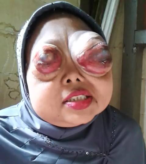 Woman with horrific Face the eyes Disfigured by Cancer