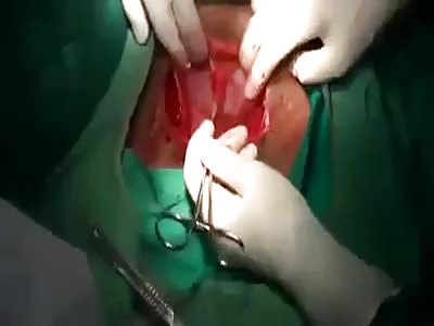 quick C-section